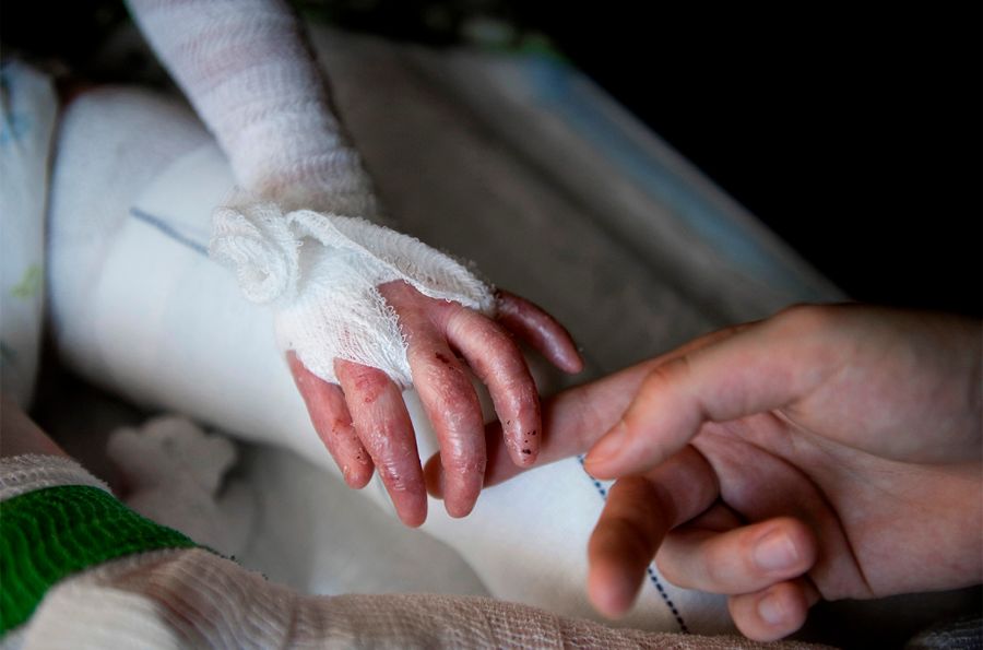 تشخیص بیماری پروانه ای در کودکان